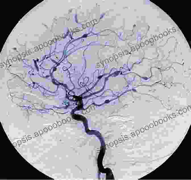 CT Angiogram Of A Cerebral Aneurysm Microneurosurgery Volume IVA: CNS Tumors: Surgical Anatomy Neuropathology Neuroradiology Neurophysiology Clinical Considerations Operability Treatment Options