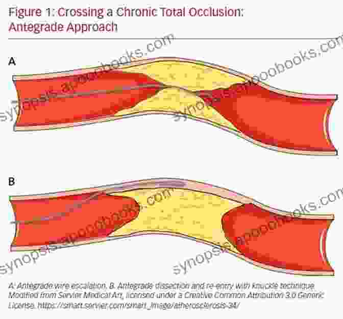 Drug Eluting Stent Current Trend And Techniques Of Percutaneous Coronary Intervention For Chronic Total Occlusion