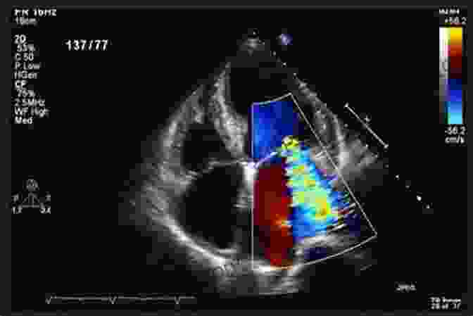 Echocardiogram Image Showing Heart Valves Transcatheter Aortic Valve Replacement: A How To Guide For Cardiologists And Cardiac Surgeons