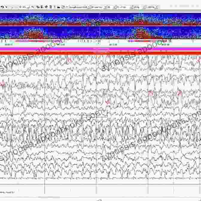 EEG Recording Showing Epileptic Activity Microneurosurgery Volume IVA: CNS Tumors: Surgical Anatomy Neuropathology Neuroradiology Neurophysiology Clinical Considerations Operability Treatment Options