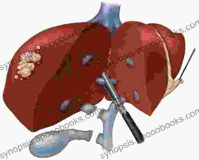 Laparoscopic Hepatectomy Illustration Laparoscopic Hepatectomy: Atlas And Techniques