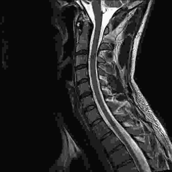 MRI Scan Of The Cervical Spine Microneurosurgery Volume IVA: CNS Tumors: Surgical Anatomy Neuropathology Neuroradiology Neurophysiology Clinical Considerations Operability Treatment Options