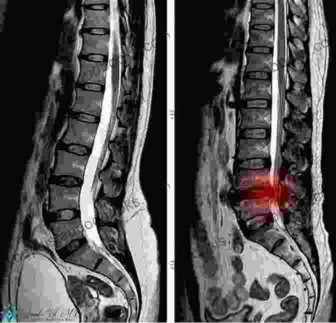 MRI Scan Of The Lumbar Spine Microneurosurgery Volume IVA: CNS Tumors: Surgical Anatomy Neuropathology Neuroradiology Neurophysiology Clinical Considerations Operability Treatment Options