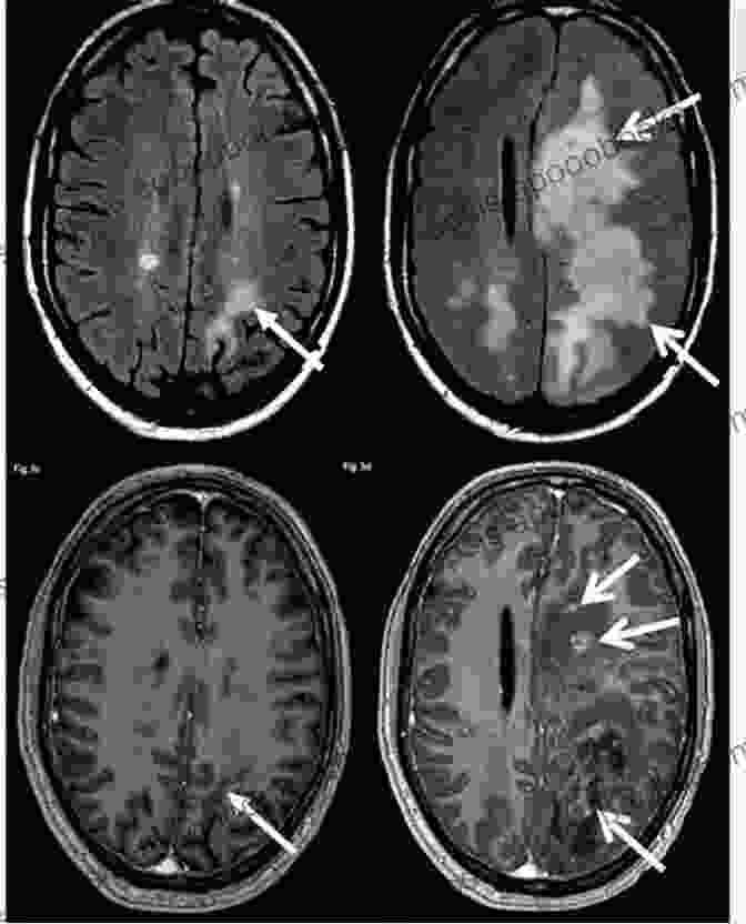 MRI Scan Showing Multiple Sclerosis Plaques Microneurosurgery Volume IVA: CNS Tumors: Surgical Anatomy Neuropathology Neuroradiology Neurophysiology Clinical Considerations Operability Treatment Options