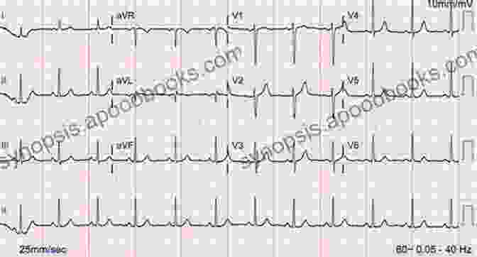 Twelve Lead EKG Showing Normal Sinus Rhythm Twelve Lead Electrocardiography: Theory And Interpretation